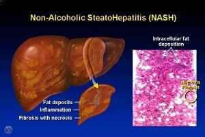 Nonalcoholic-Steatohepatitis-Market