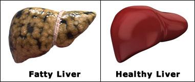 fatty & healthy liver