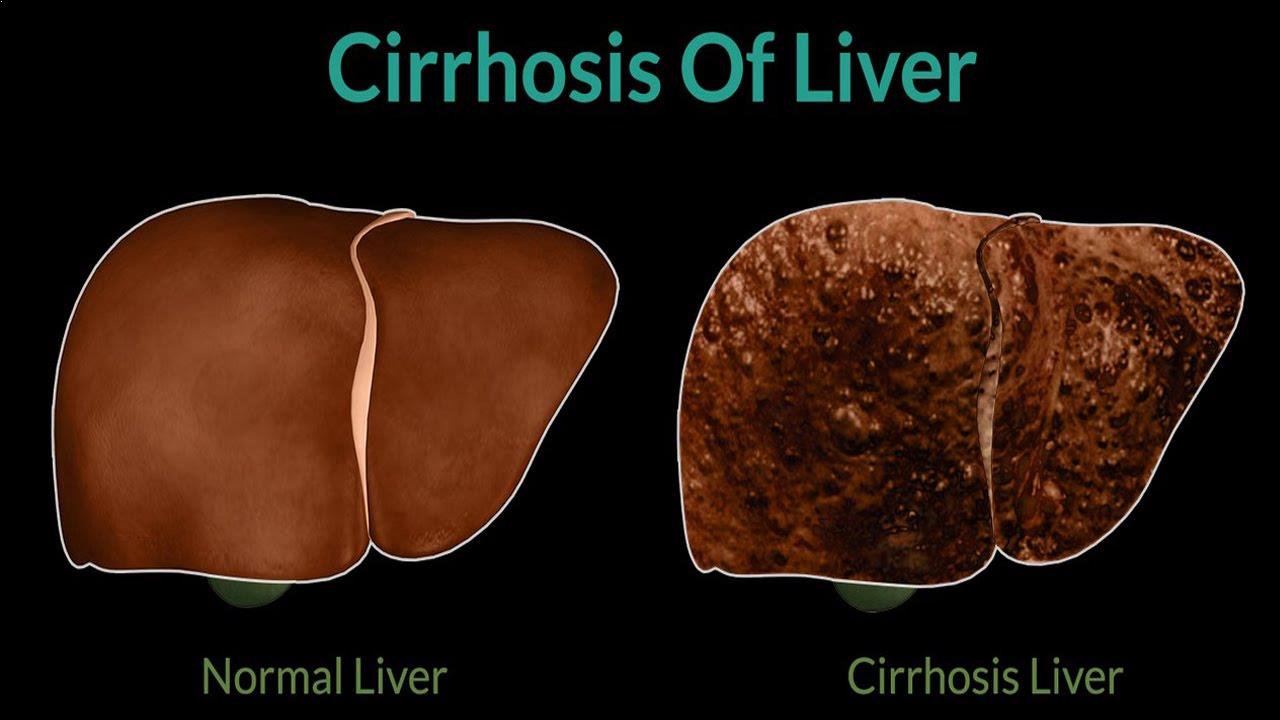 cirrhosis of liver