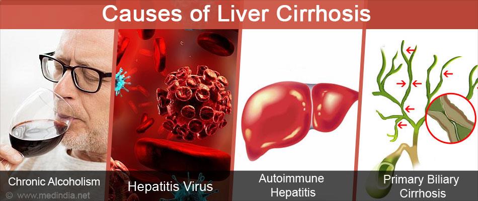 causes f liver cirrhosis