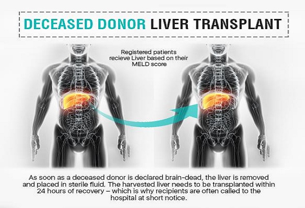 Decrease donor liver transplant