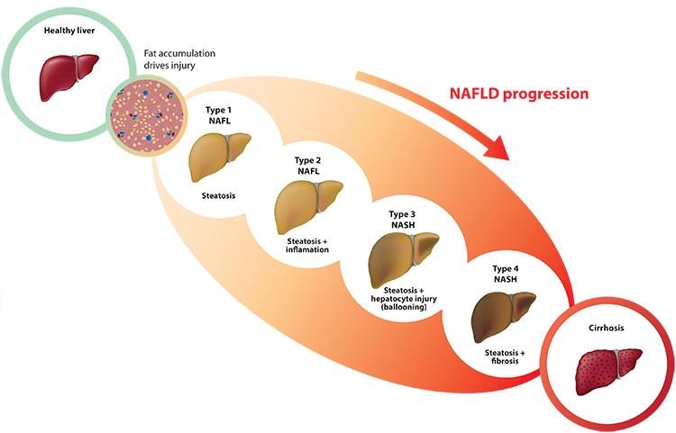 NAFLD Progression
