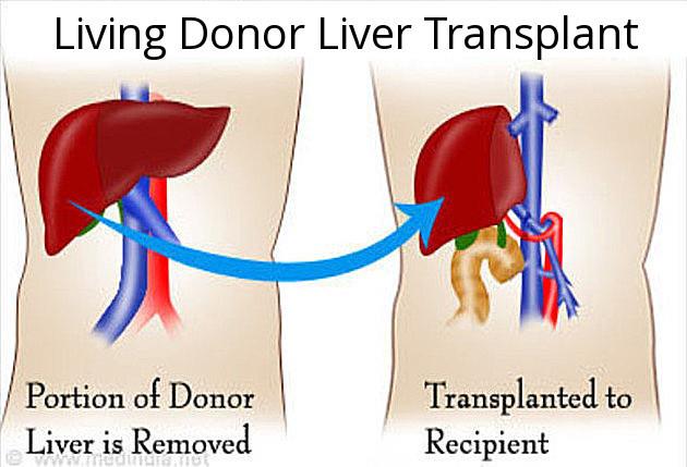 living donor liver transplant