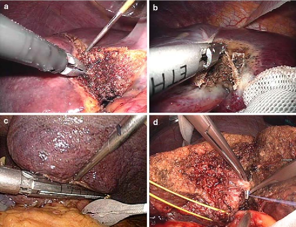 Liver operation